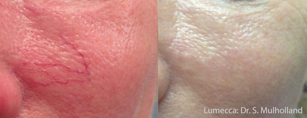 Before and After Image: Red Spots and Vessels - front