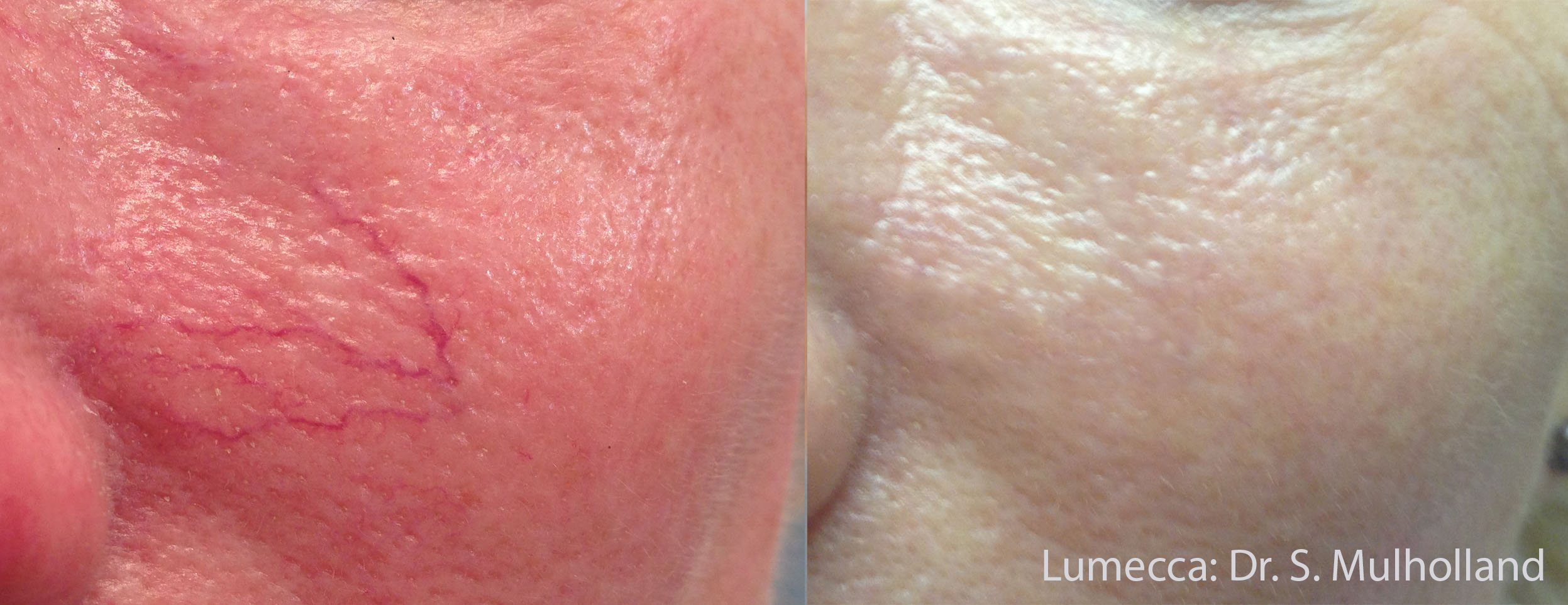 Before and After Image: Red Spots and Vessels - front