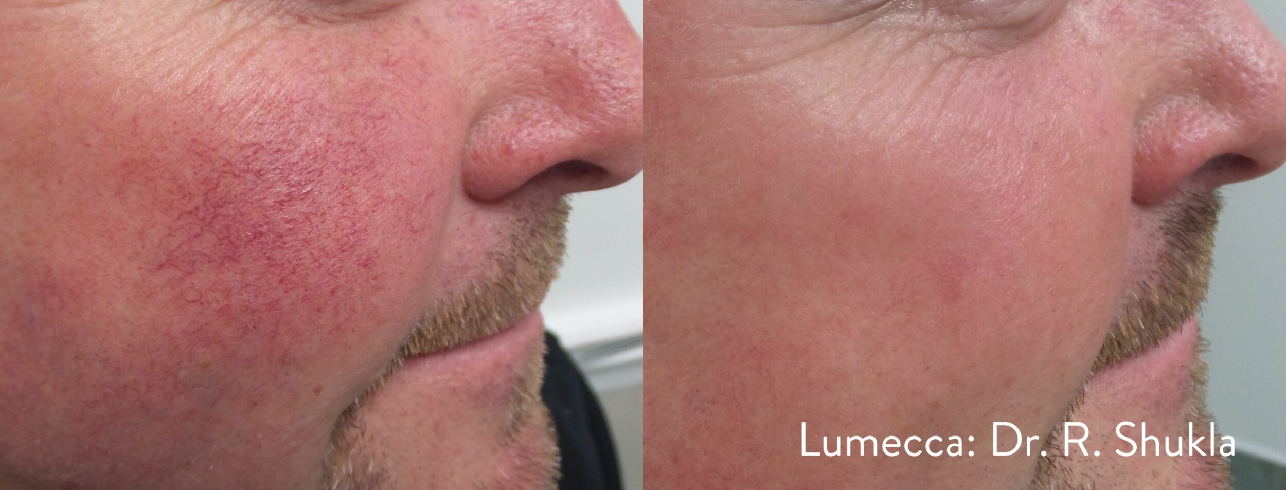 Before and After Image: Red Spots and Vessels - right-side