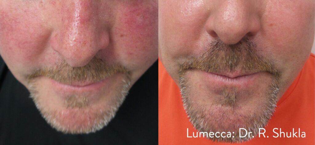 Before and After Image: Red Spots and Vessels - front