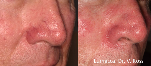 Before and After Image: Red Spots and Vessels - right-front-oblique