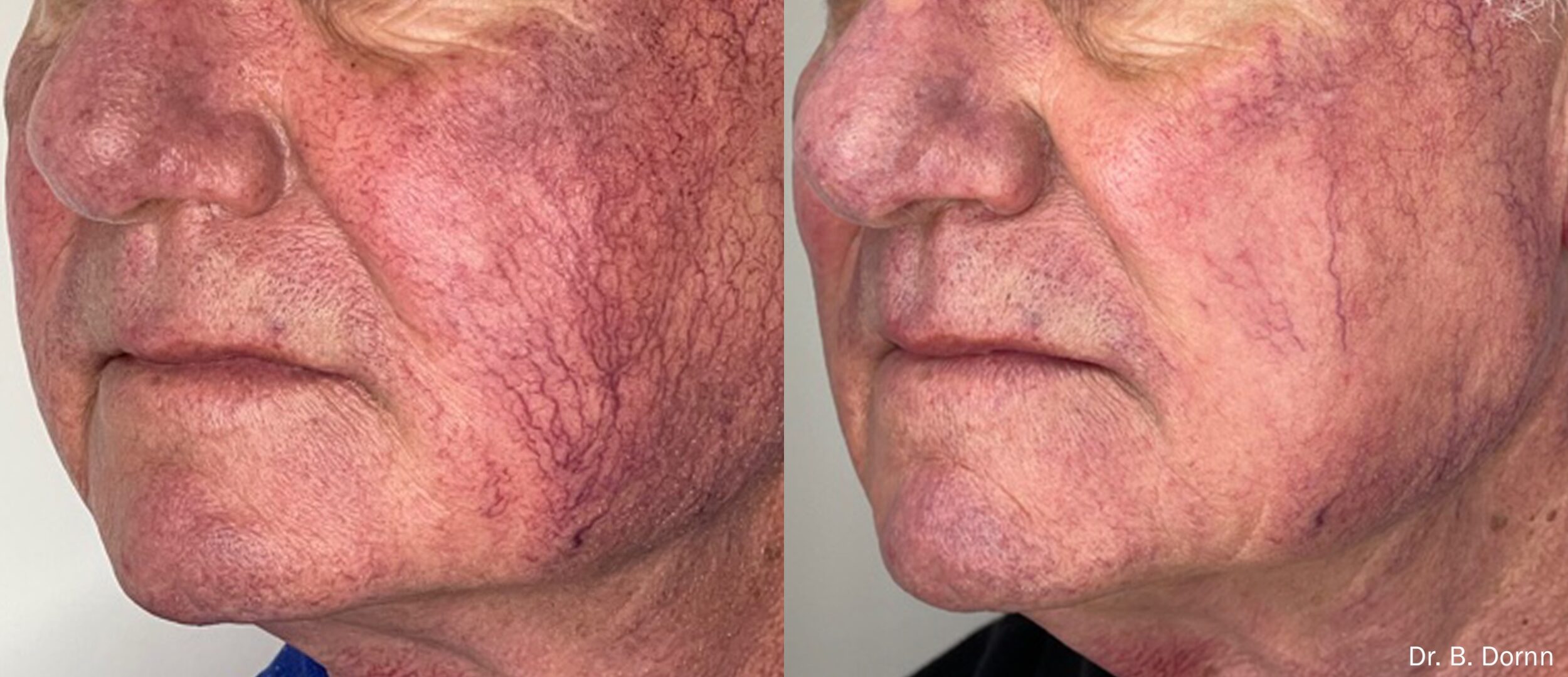 Before and After Image: Red Spots and Vessels - left-front-oblique