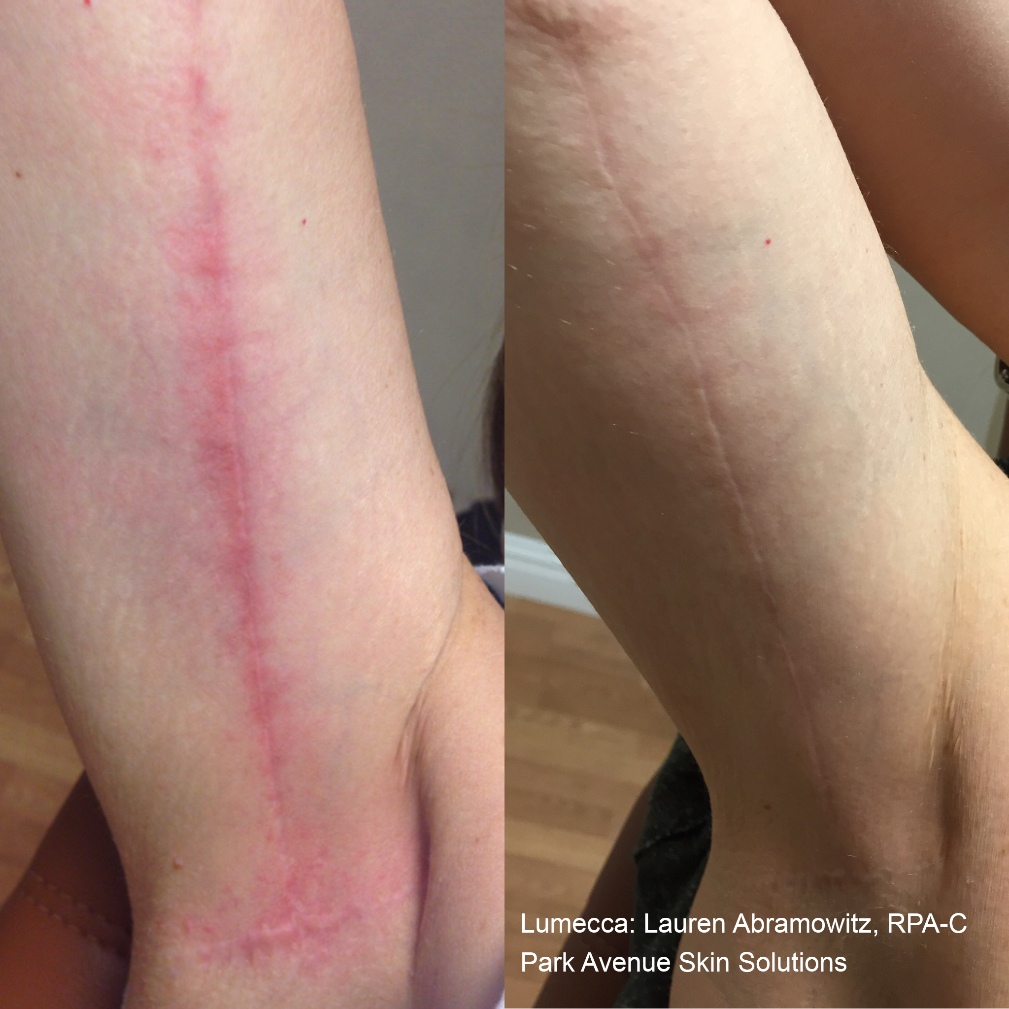 Before and After Image: Scar - front