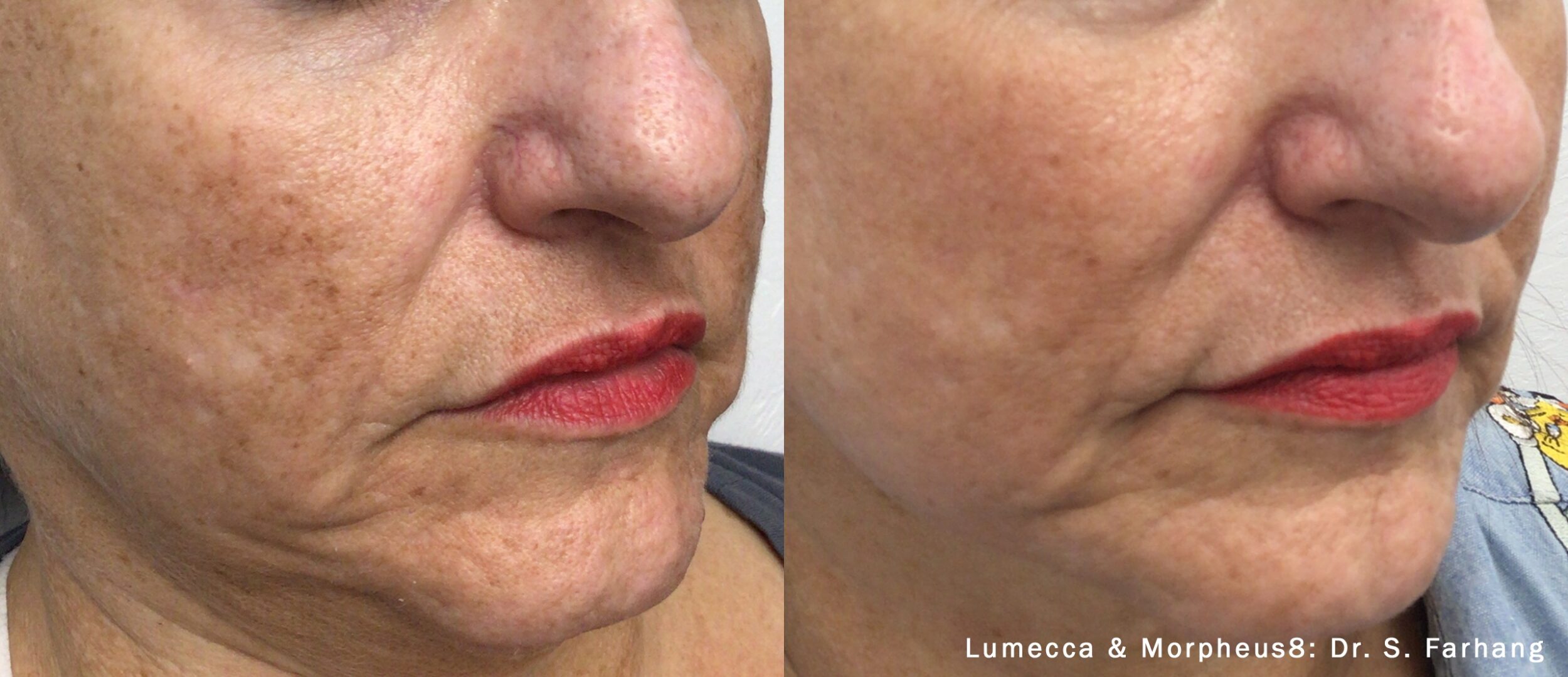 Before and After Image: IPL and Morpheus Face - right-front-oblique
