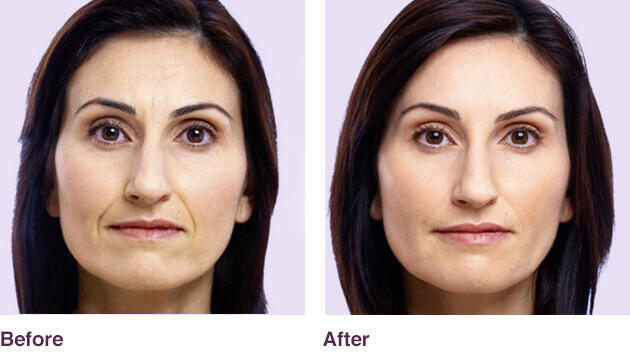 Before and After Image: Juvederm - front