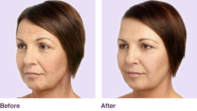 Before and After Image: Juvederm - left-front-oblique