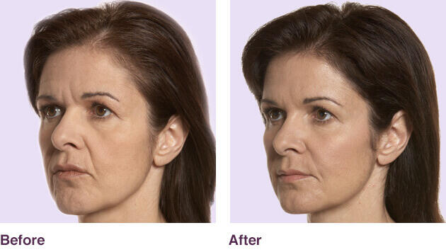 Before and After Image: Juvederm - left-front-oblique