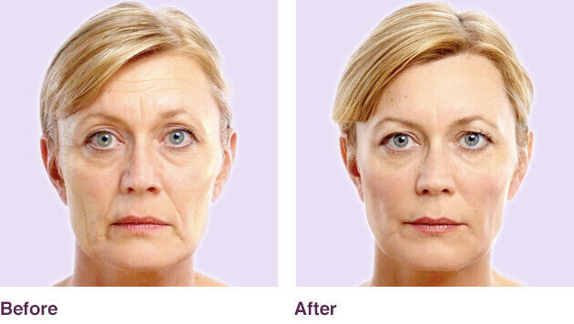 Before and After Image: Juvederm - front
