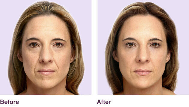 Before and After Image: Juvederm - front