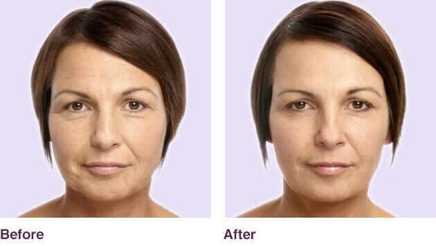 Before and After Image: Juvederm - front