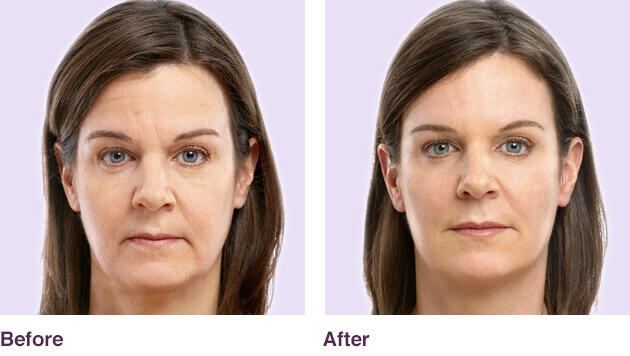 Before and After Image: Juvederm - front