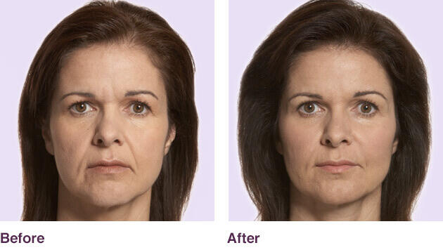 Before and After Image: Juvederm - front