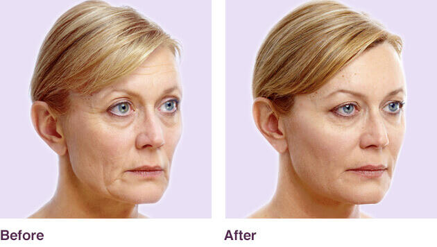 Before and After Image: Juvederm - right-front-oblique