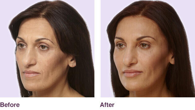 Before and After Image: Juvederm - left-front-oblique