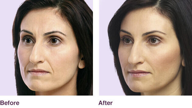 Before and After Image: Juvederm - left-front-oblique