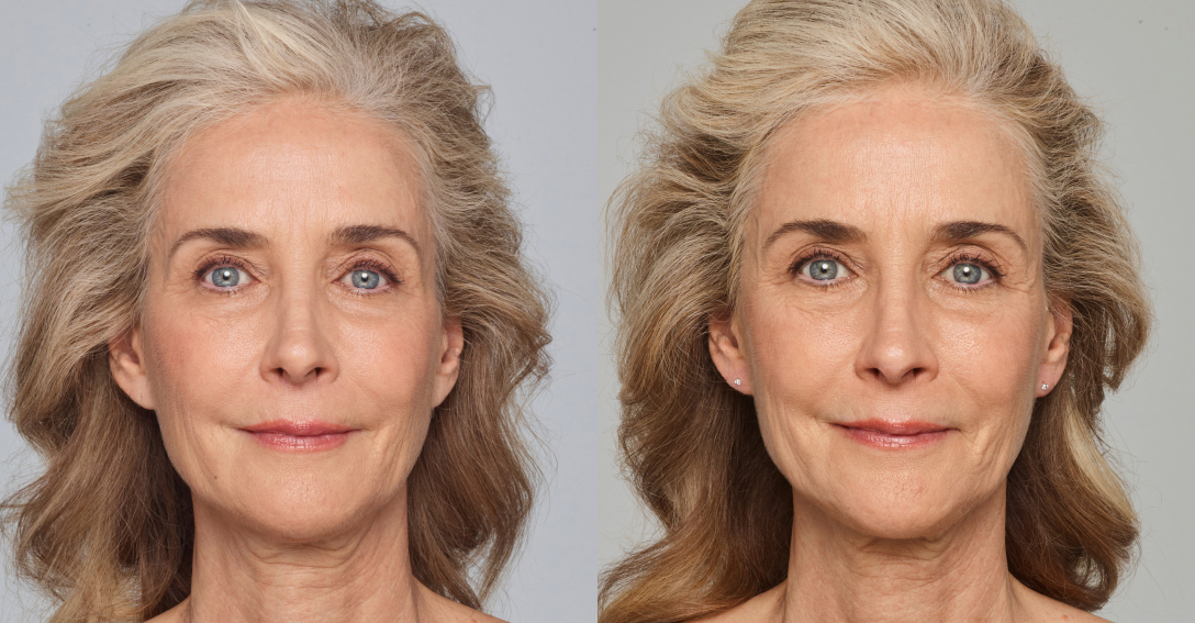Before and After Image: Juvederm - front