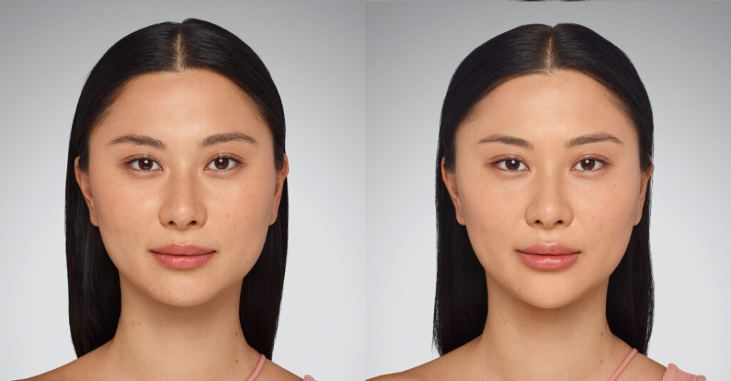Before and After Image: Juvederm - front