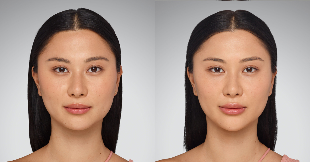 Before and After Image: Juvederm - front