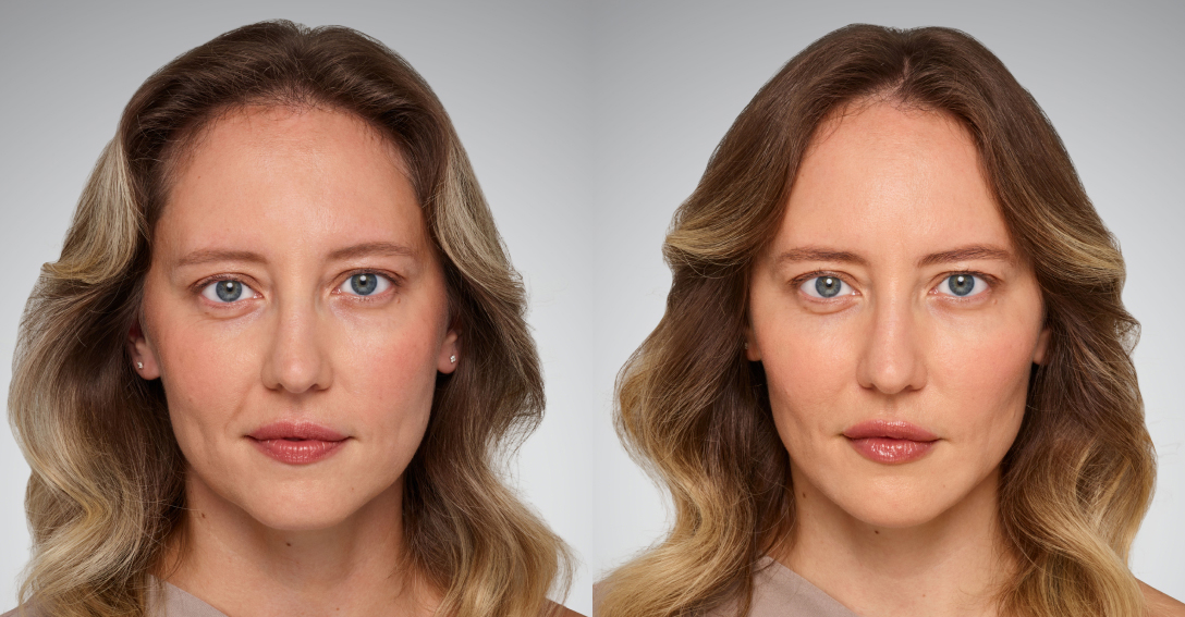 Before and After Image: Juvederm - front