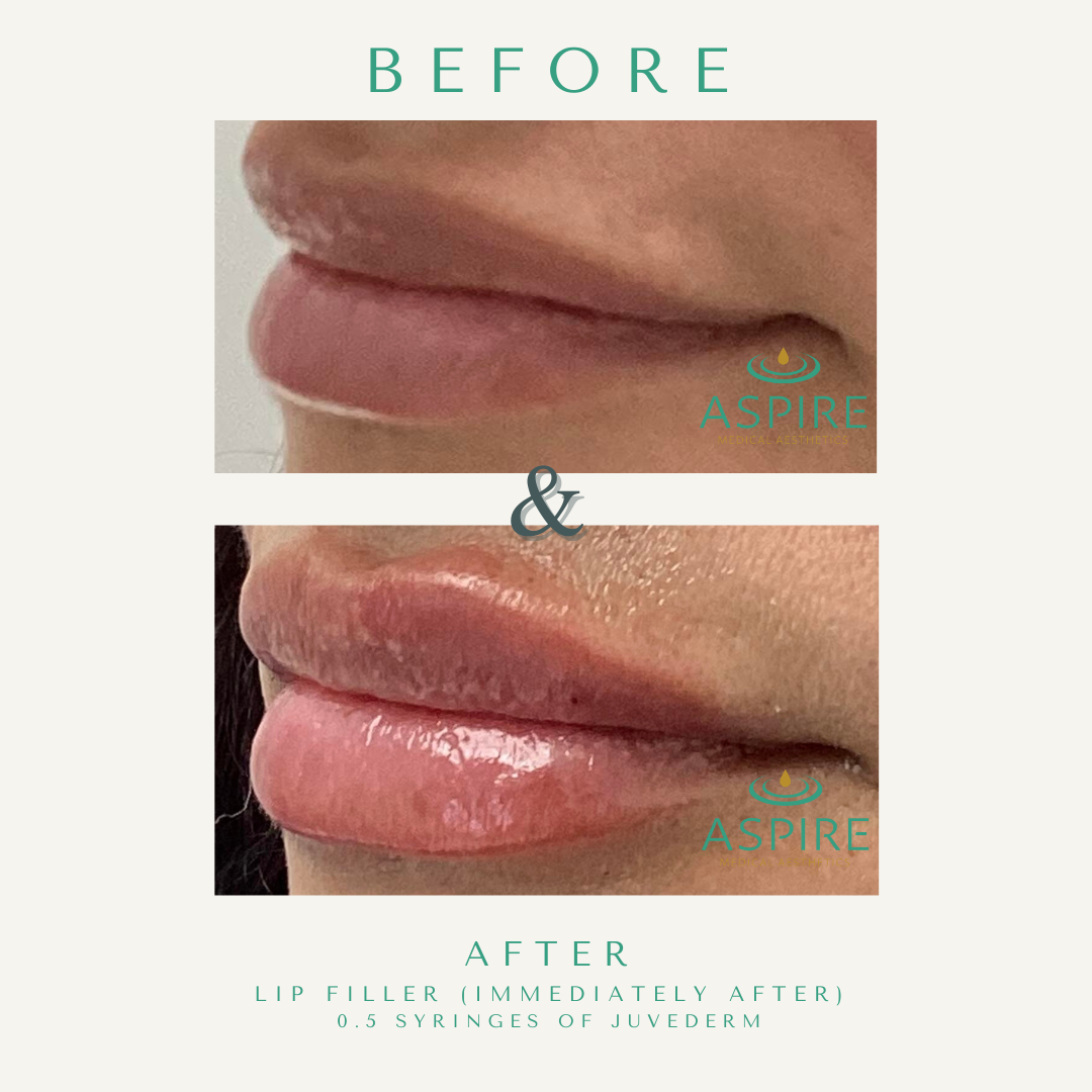 Before and After Image: Juvederm - left-front-oblique