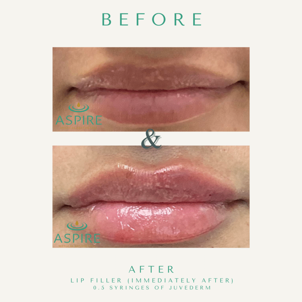 Before and After Image: Juvederm - front