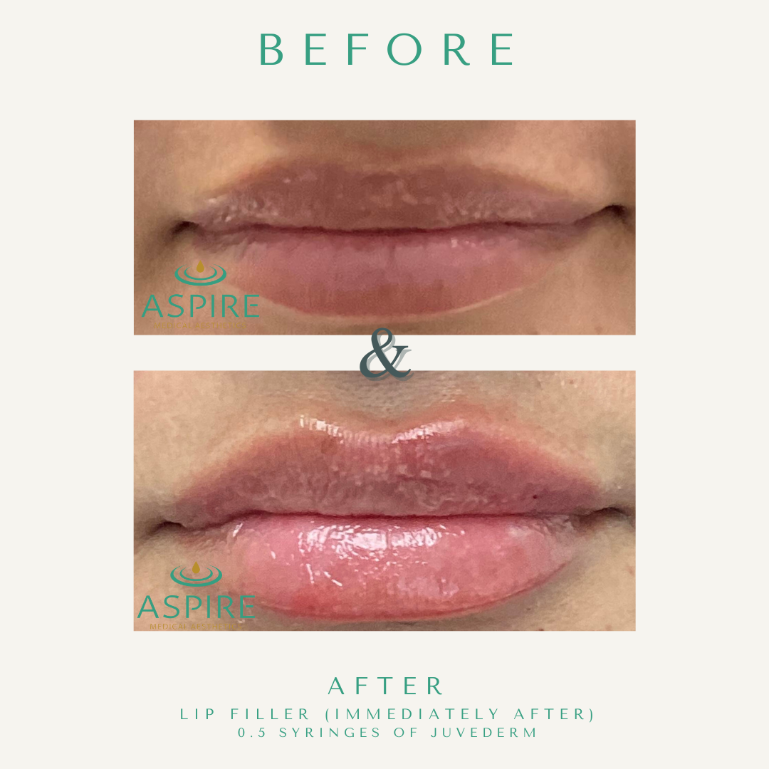 Before and After Image: Juvederm - front