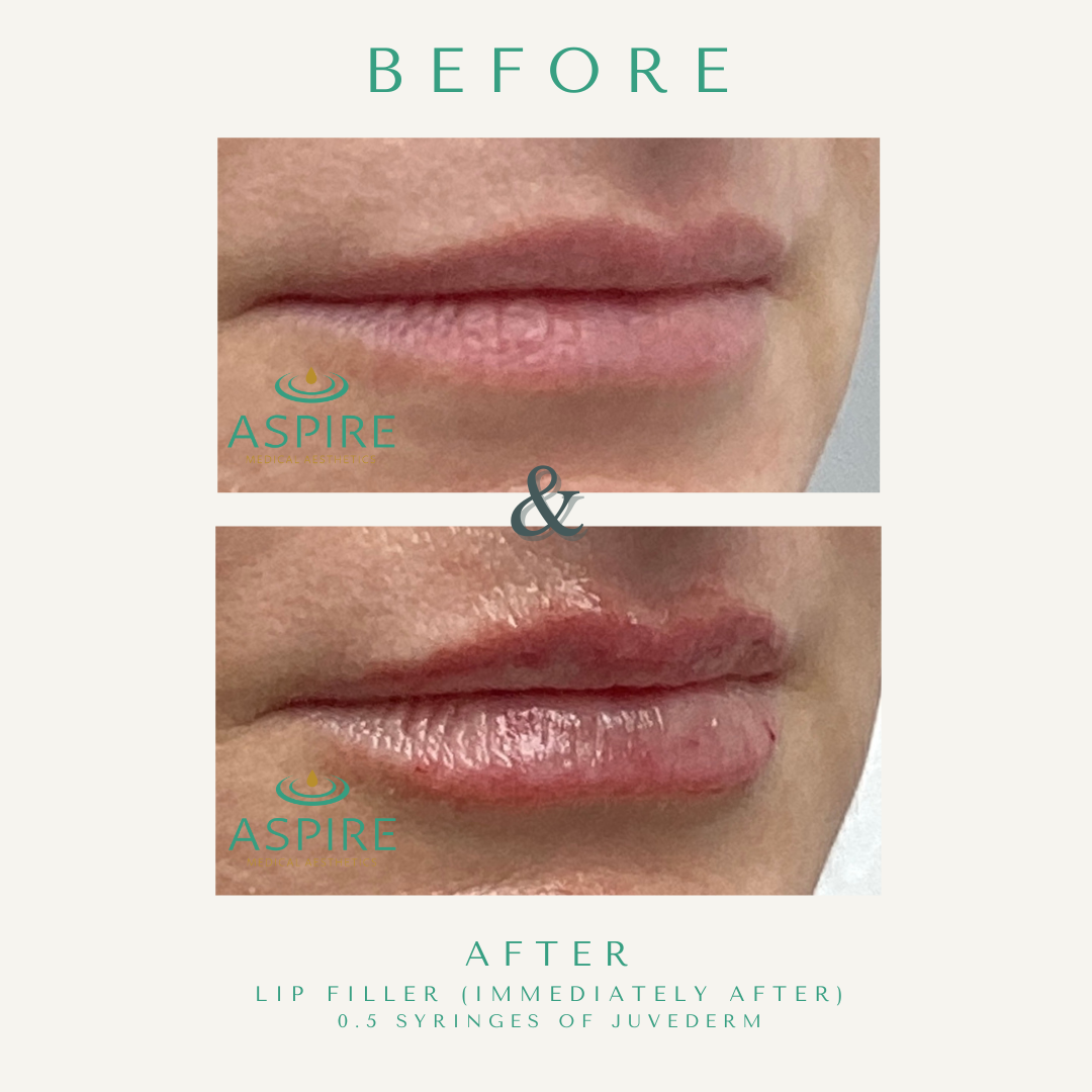 Before and After Image: Juvederm - right-front-oblique