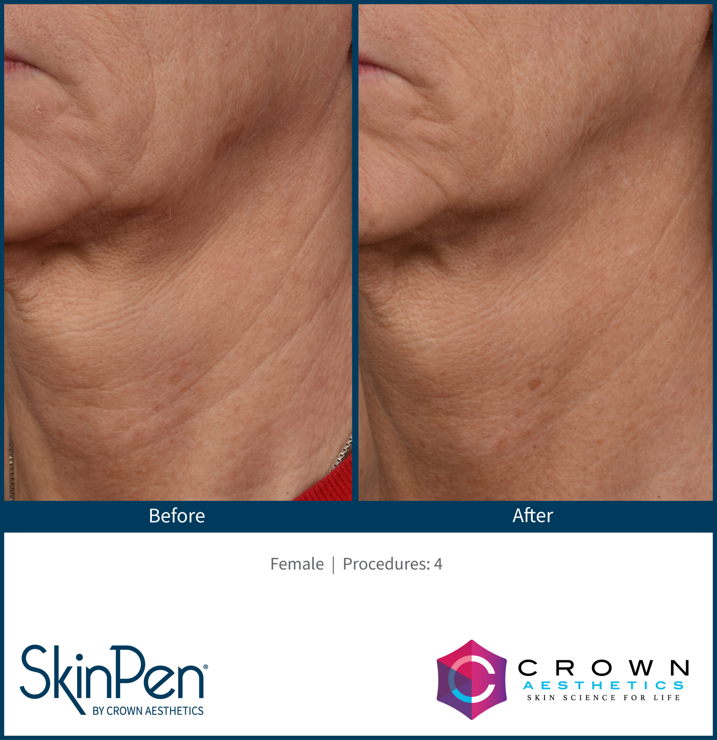 Before and After Image: SkinPen Microneedling - left-front-oblique