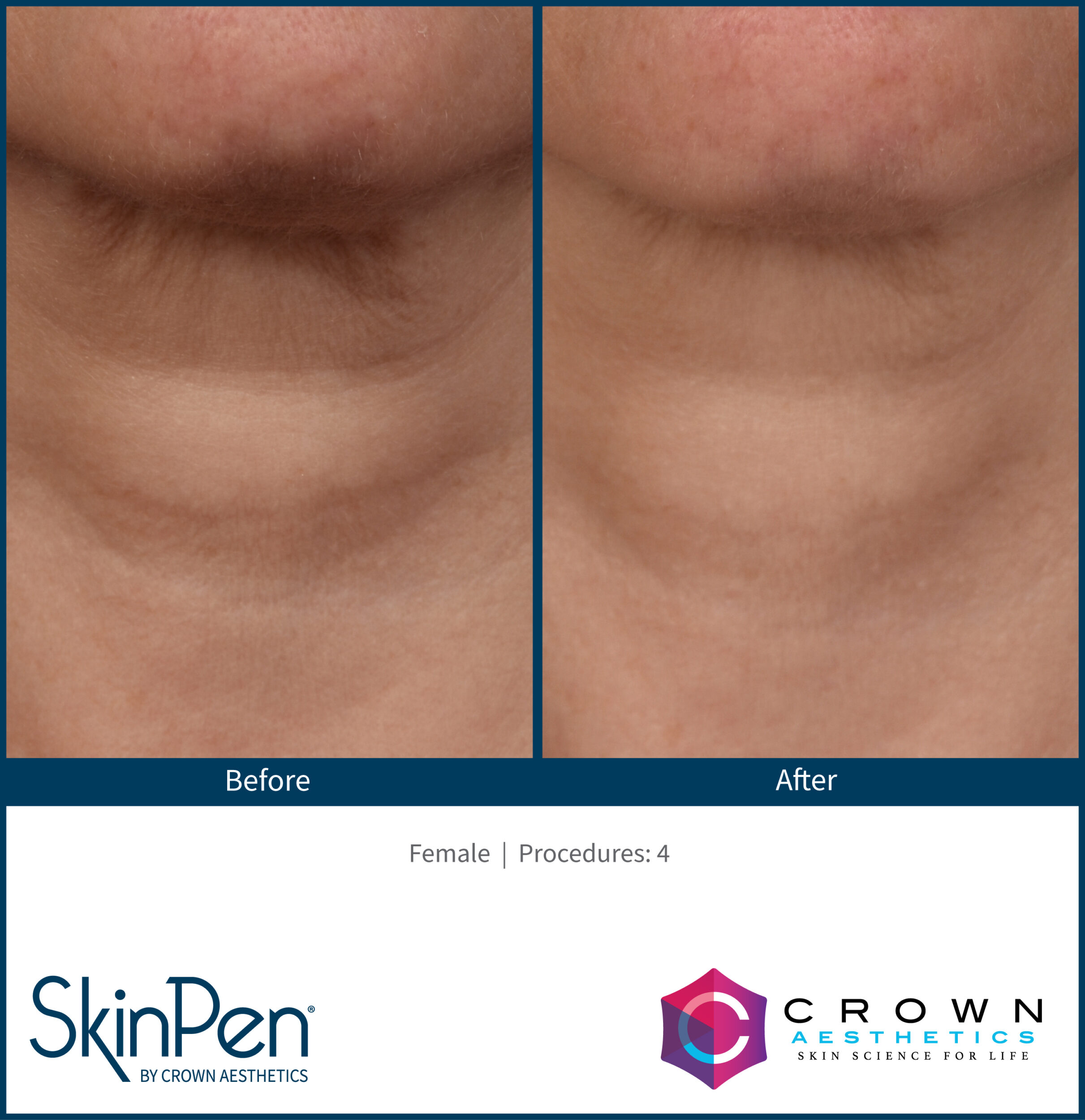 Before and After Image: SkinPen Microneedling - front