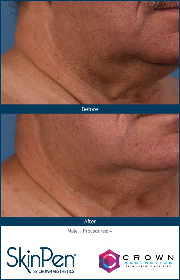 Before and After Image: SkinPen Microneedling - right-front-oblique