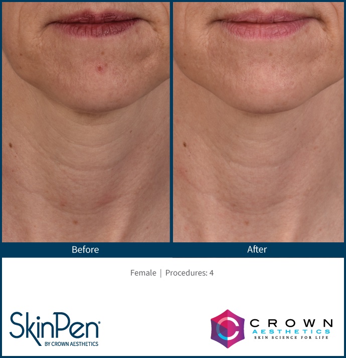 Before and After Image: SkinPen Microneedling - front