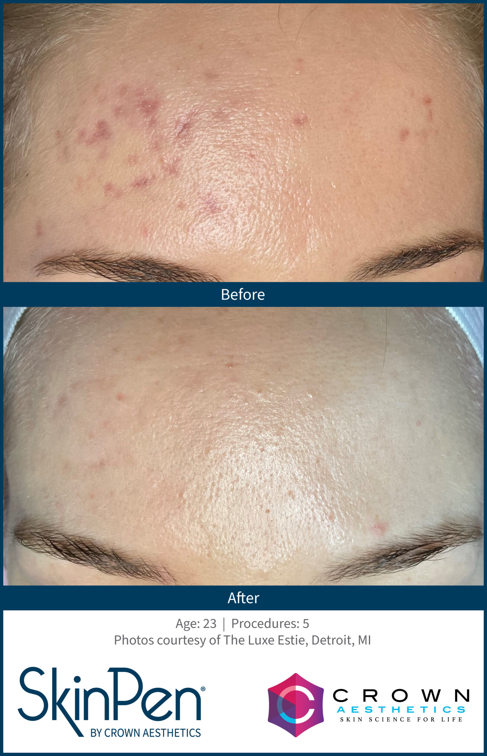 Before and After Image: SkinPen Microneedling - front