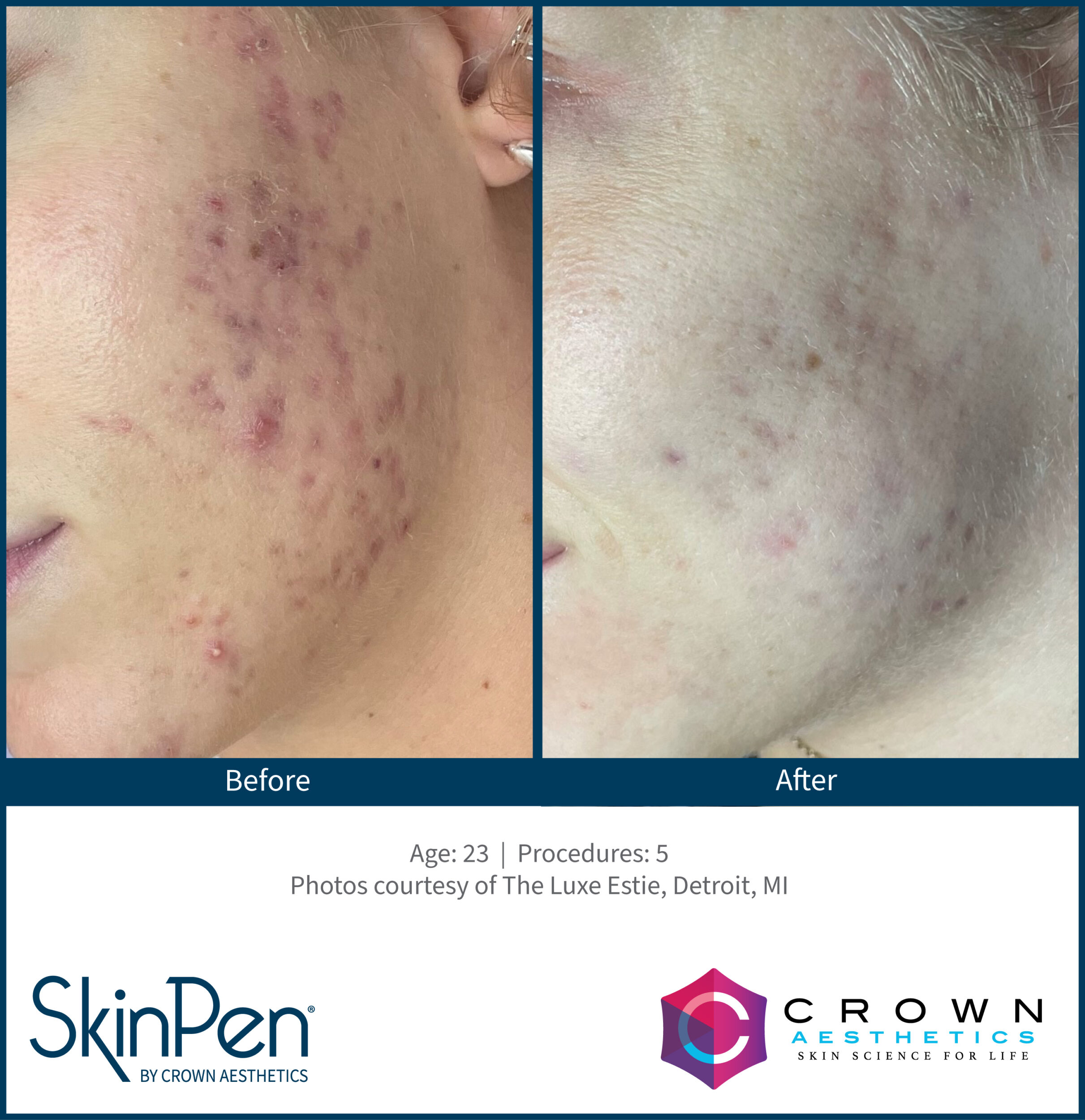 Before and After Image: SkinPen Microneedling - left-front-oblique