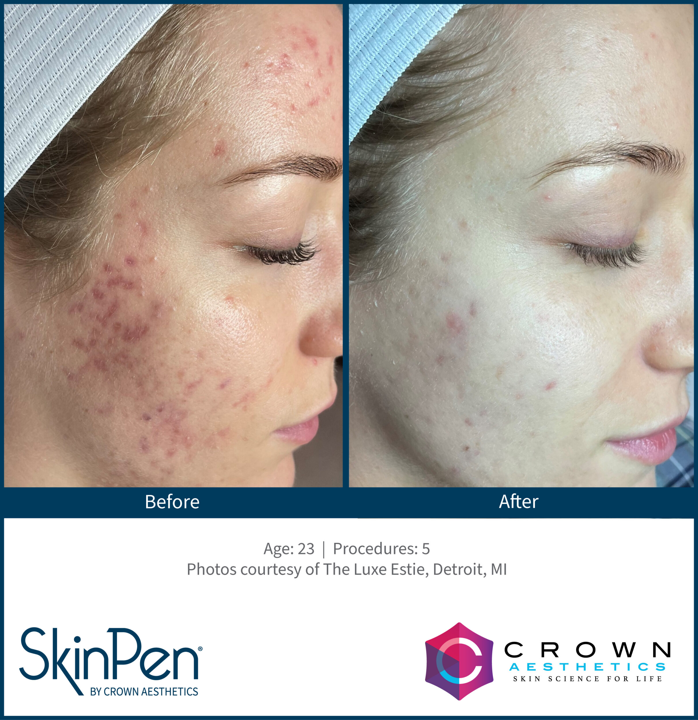 Before and After Image: SkinPen Microneedling - right-front-oblique