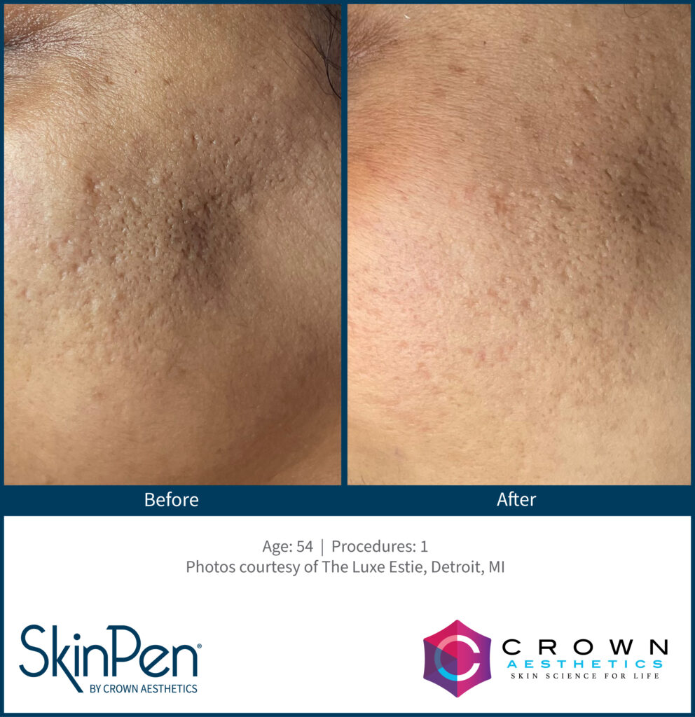 Before and After Image: SkinPen Microneedling - left-front-oblique