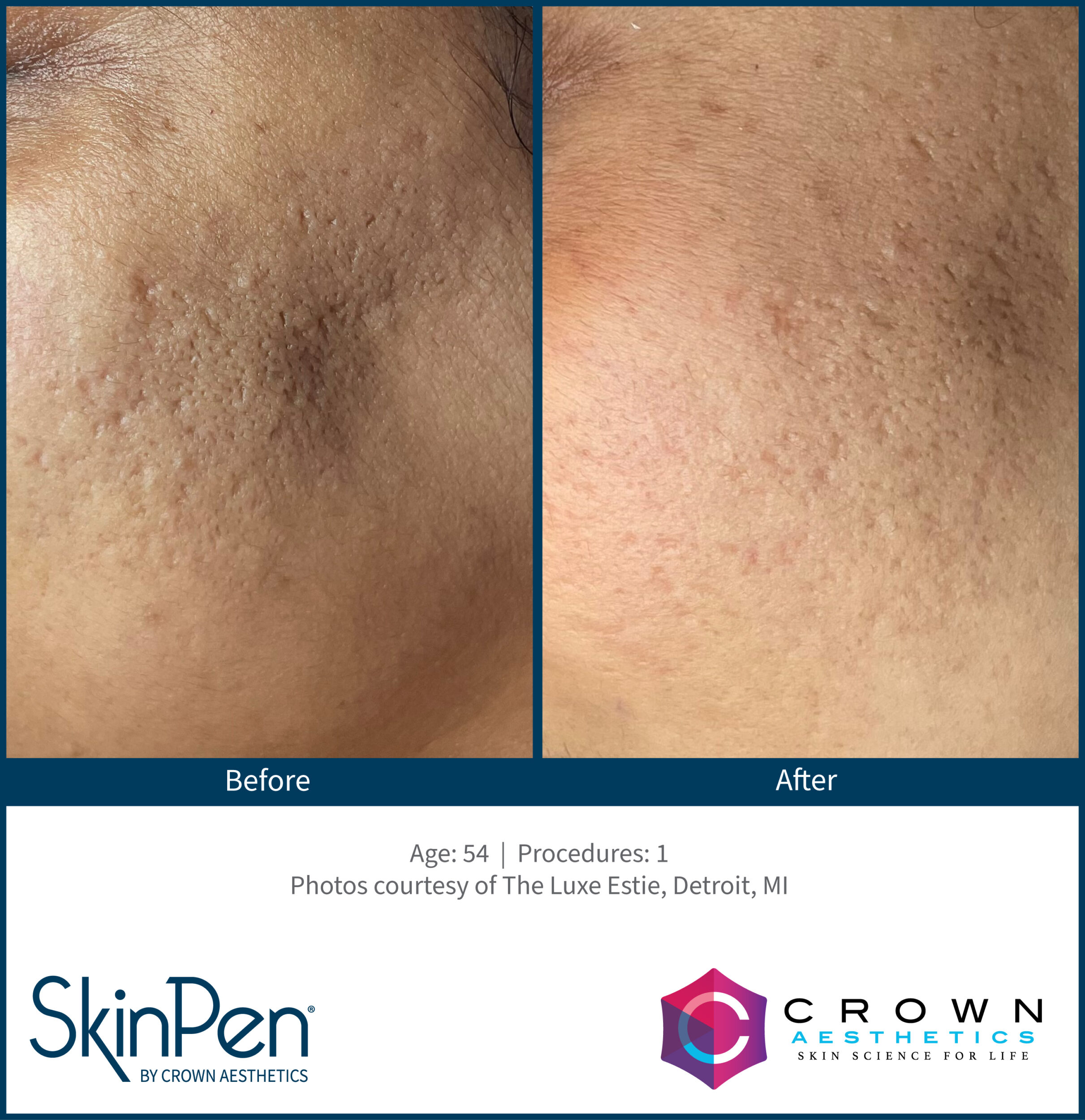 Before and After Image: SkinPen Microneedling - left-front-oblique