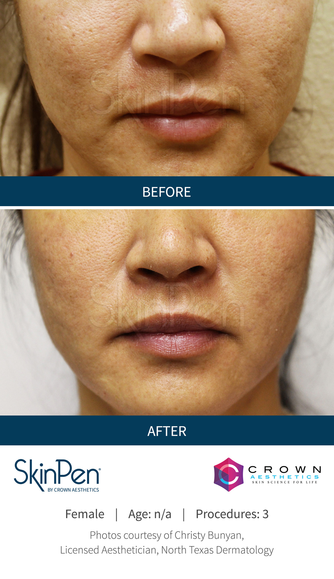 Before and After Image: SkinPen Microneedling - front