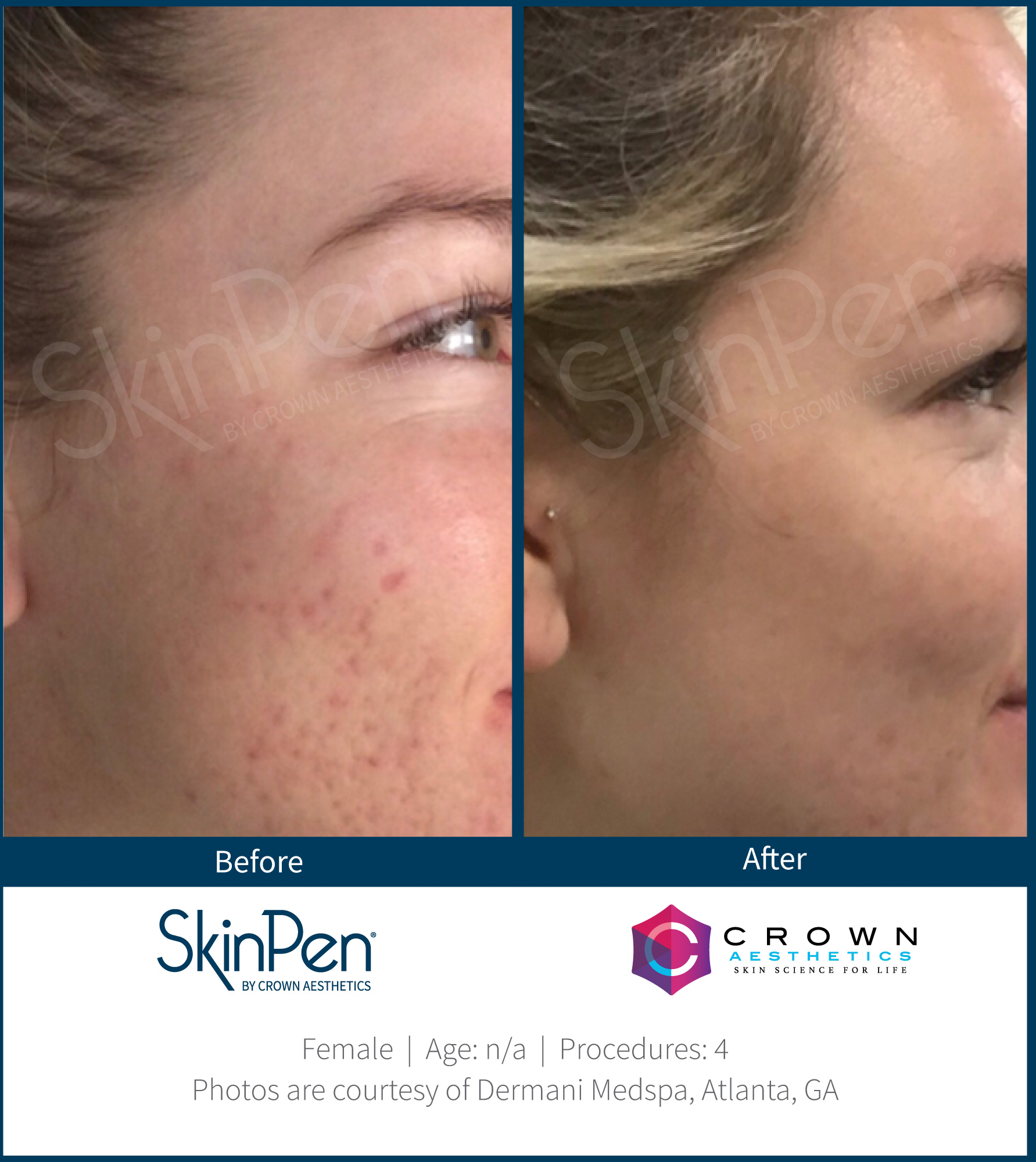 Before and After Image: SkinPen Microneedling - right-front-oblique