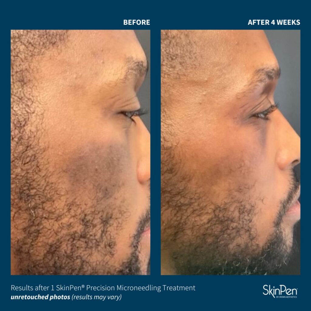 Before and After Image: SkinPen Microneedling - right-side