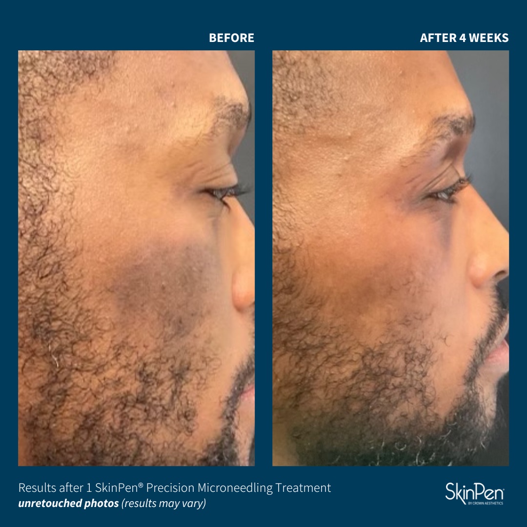Before and After Image: SkinPen Microneedling - right-side
