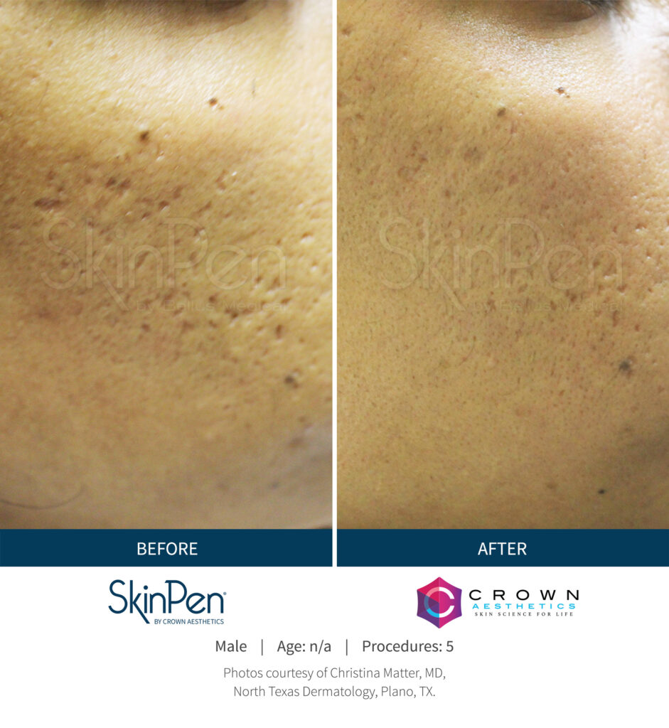 Before and After Image: SkinPen Microneedling - right-side