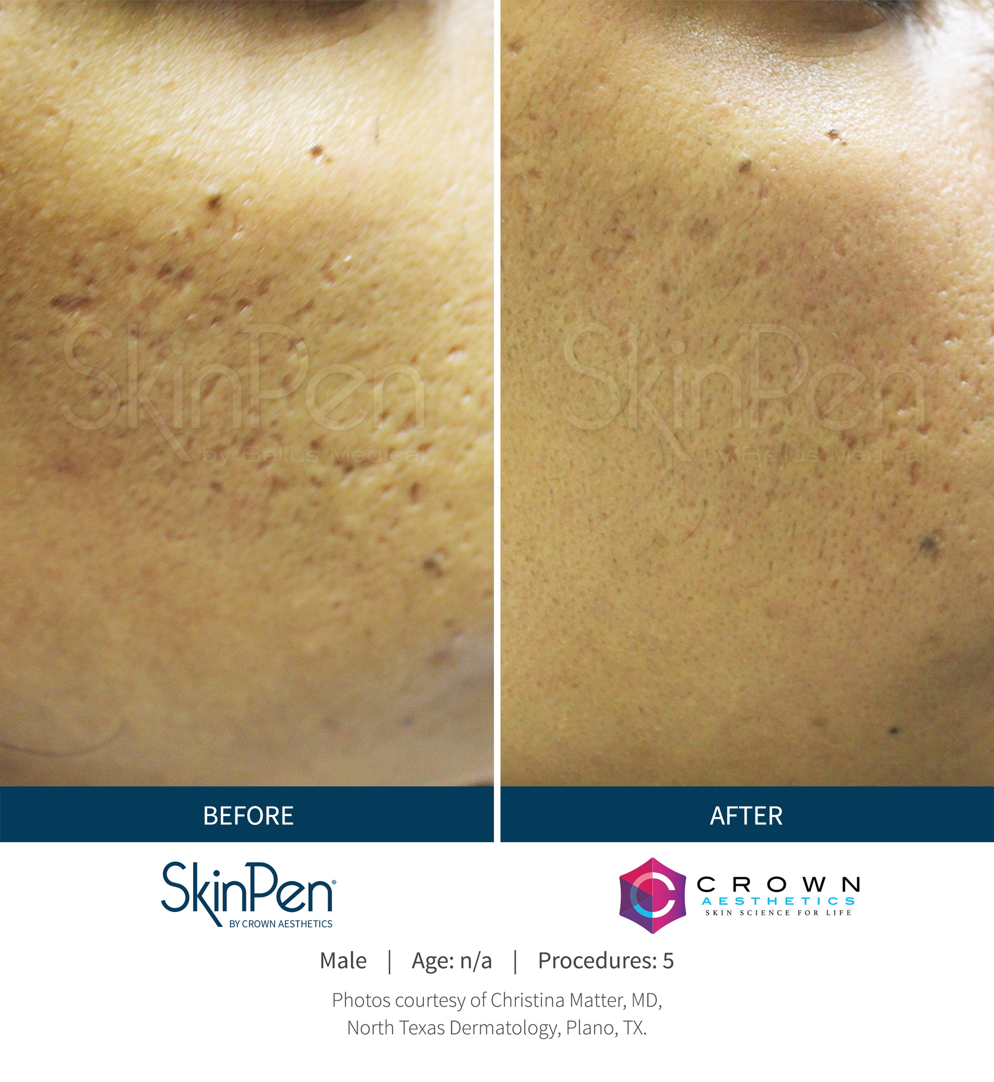 Before and After Image: SkinPen Microneedling - right-side