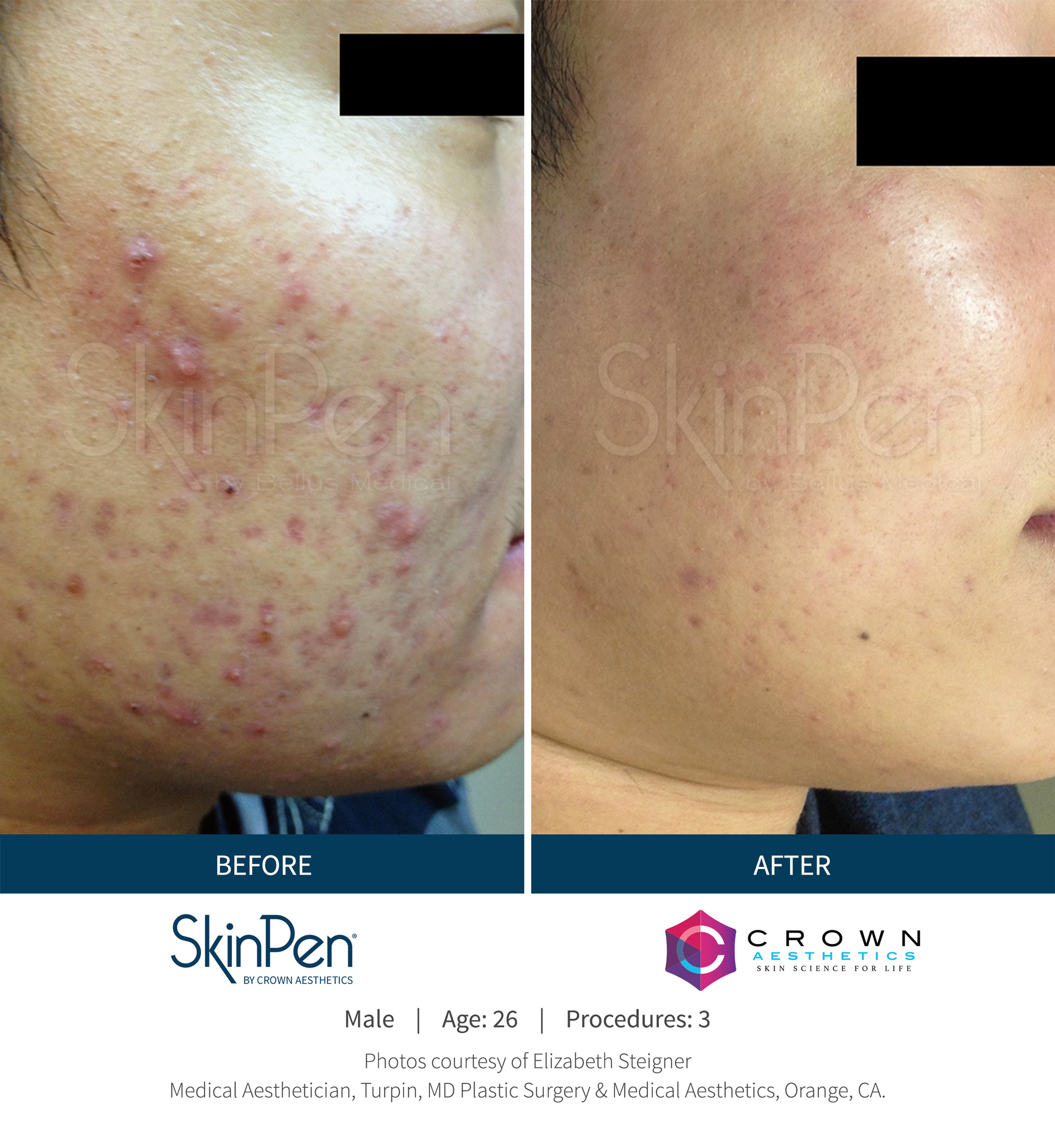 Before and After Image: SkinPen Microneedling - right-front-oblique
