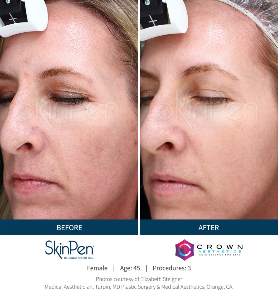 Before and After Image: SkinPen Microneedling - left-front-oblique