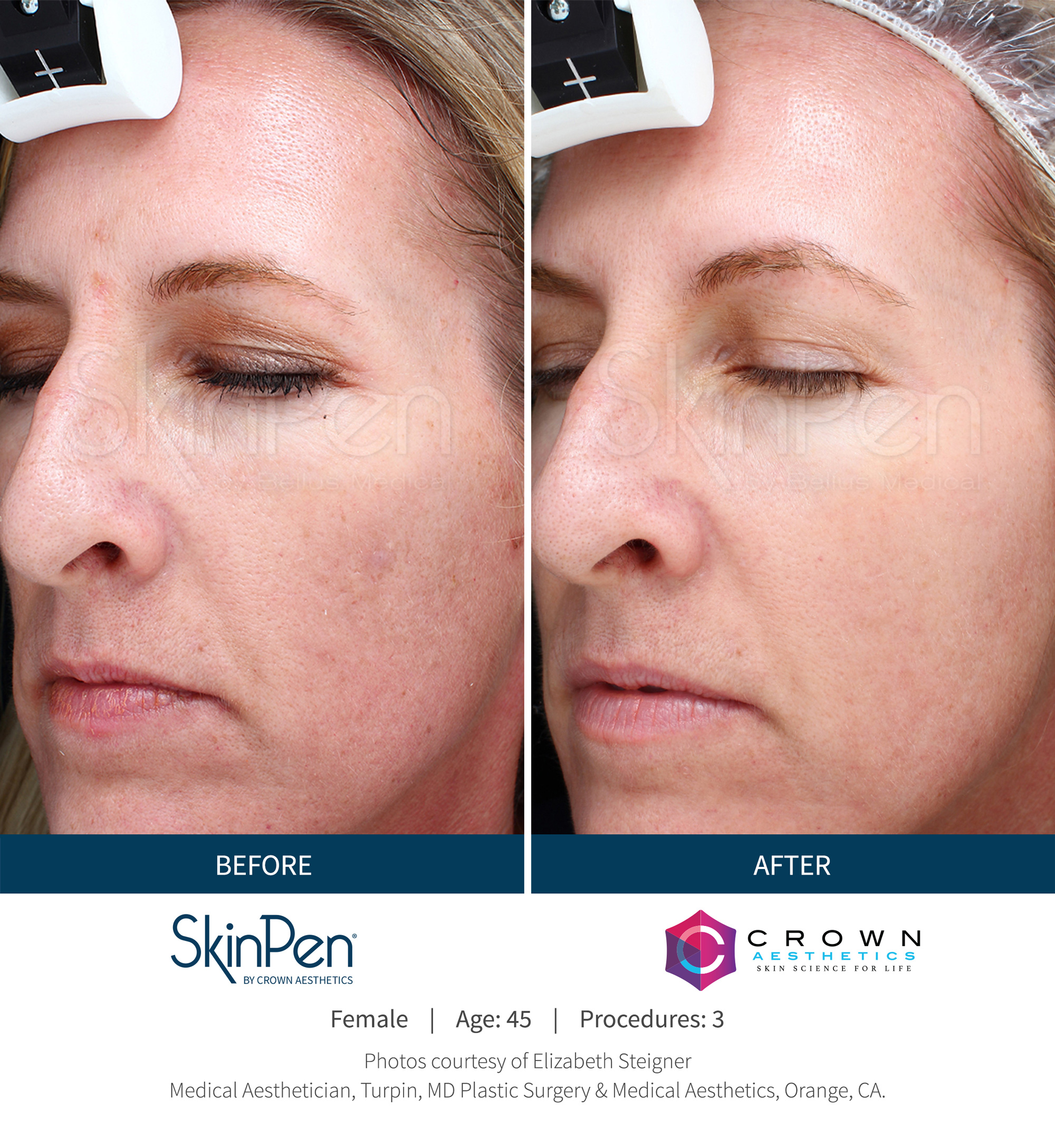 Before and After Image: SkinPen Microneedling - left-front-oblique