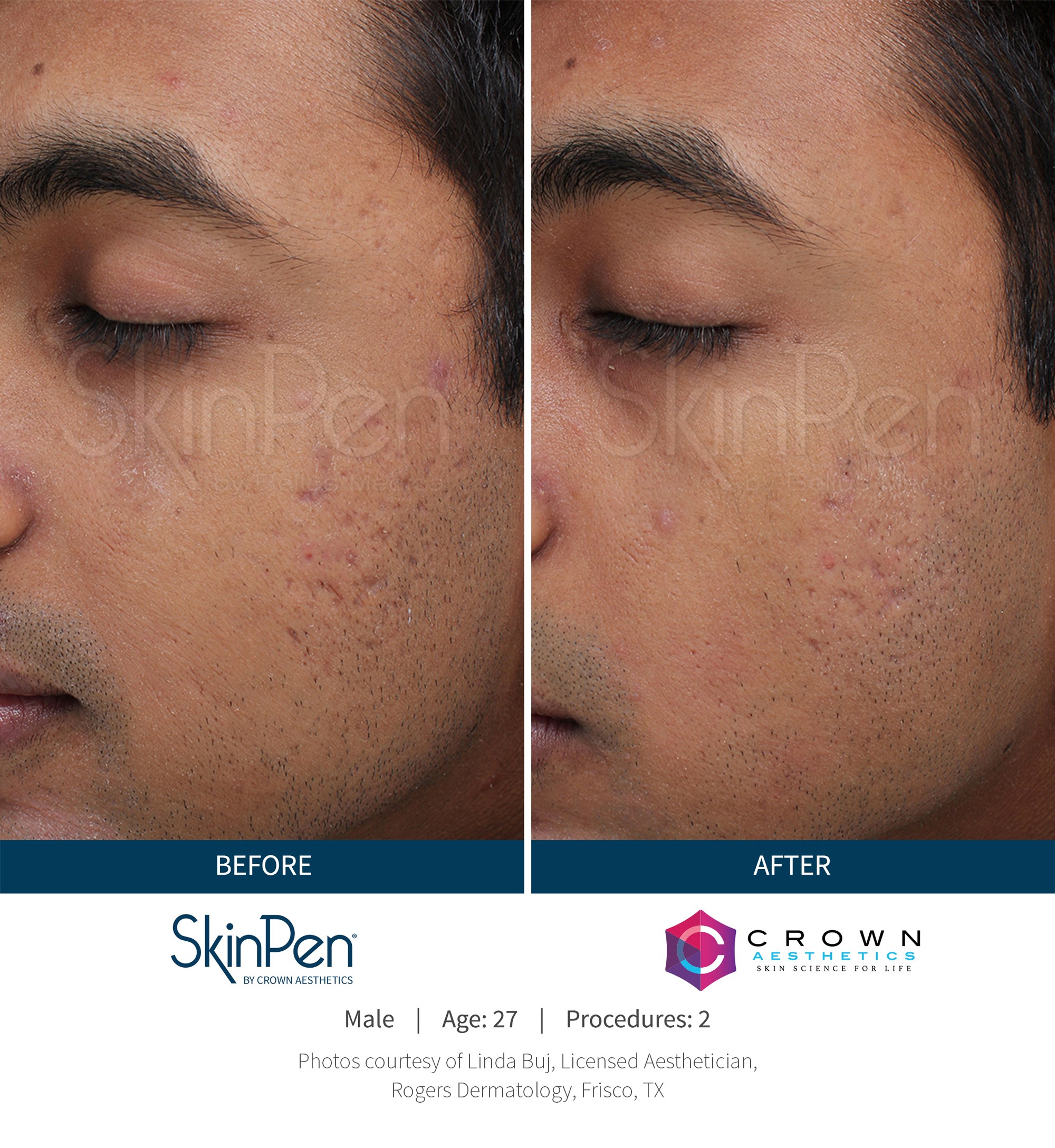 Before and After Image: SkinPen Microneedling - left-front-oblique