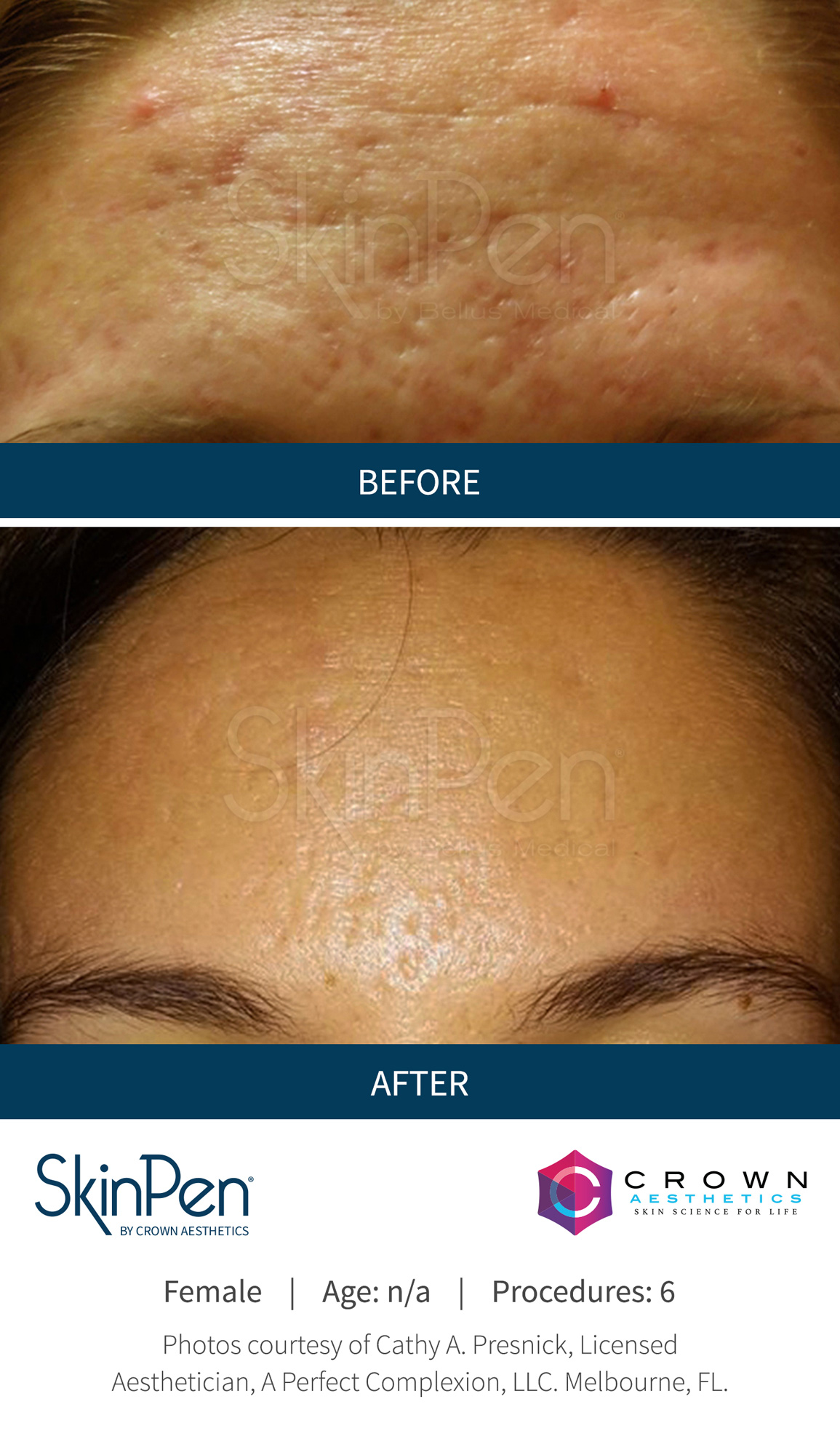 Before and After Image: SkinPen Microneedling - front