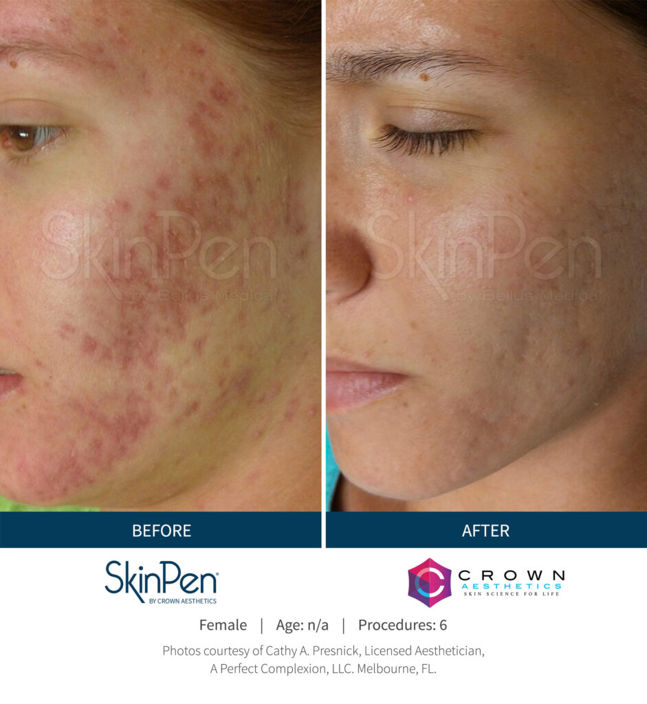 Before and After Image: SkinPen Microneedling - left-front-oblique