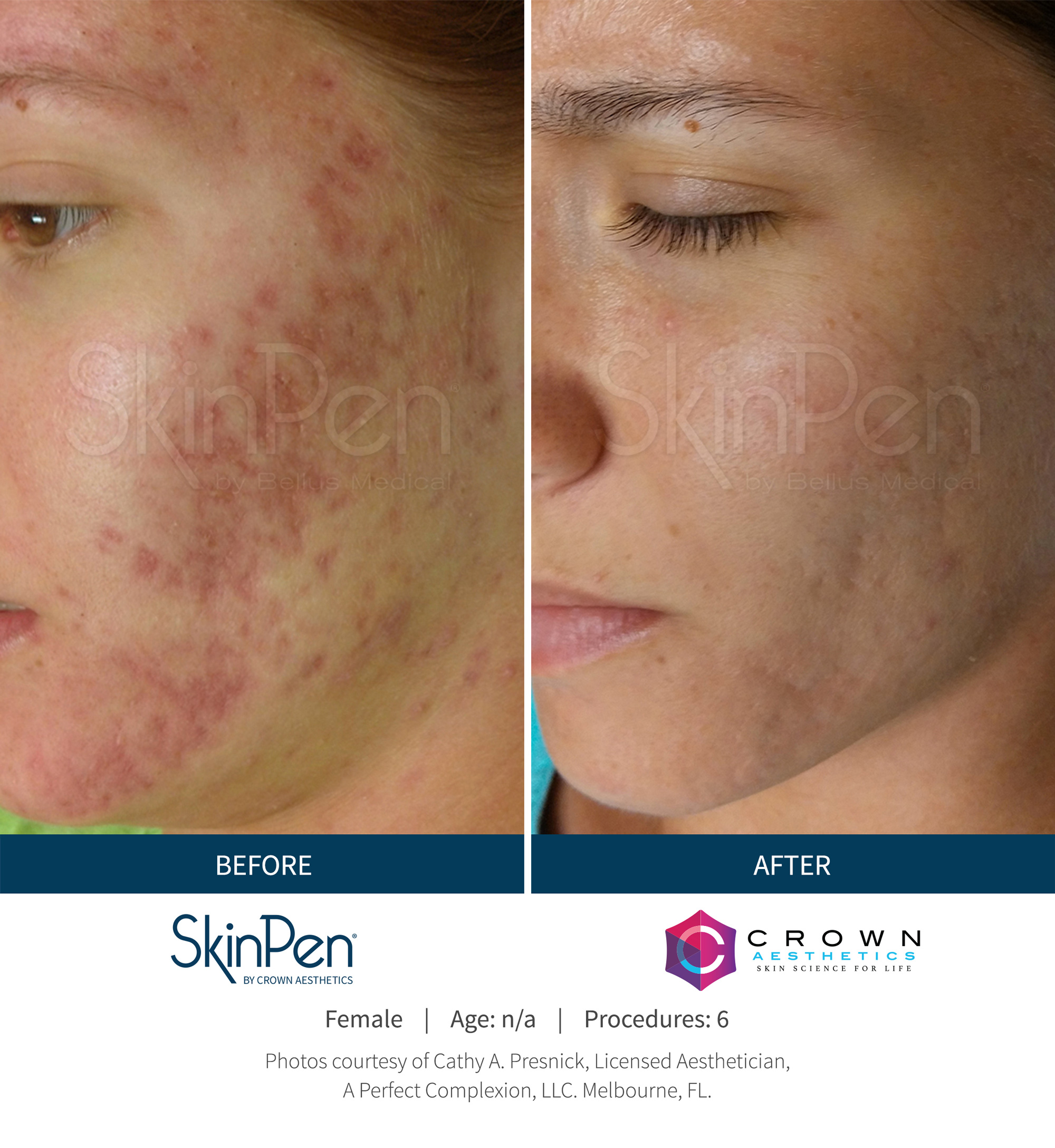 Before and After Image: SkinPen Microneedling - left-front-oblique