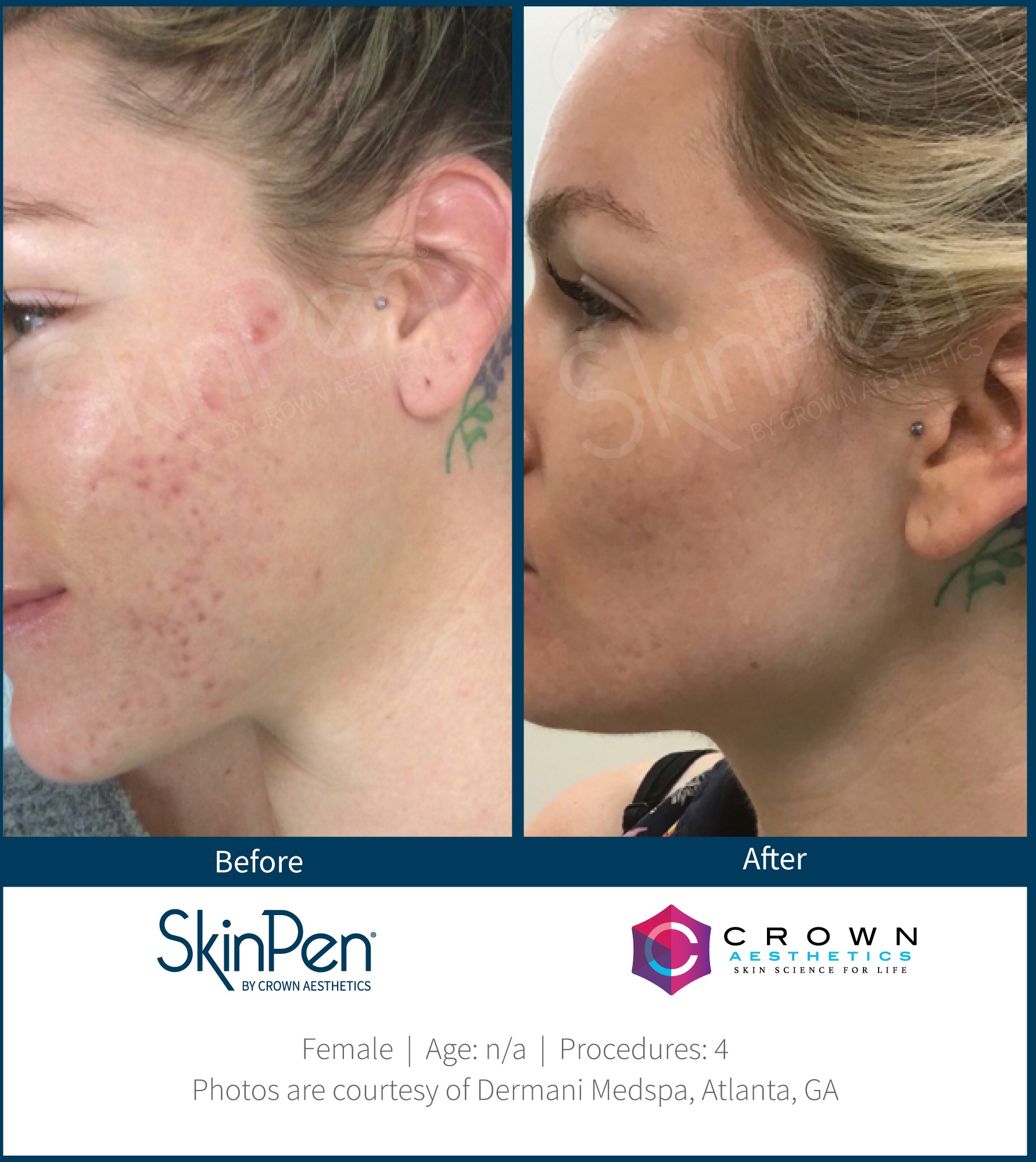 Before and After Image: SkinPen Microneedling - left-side